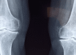 Bone Marrow Therapy