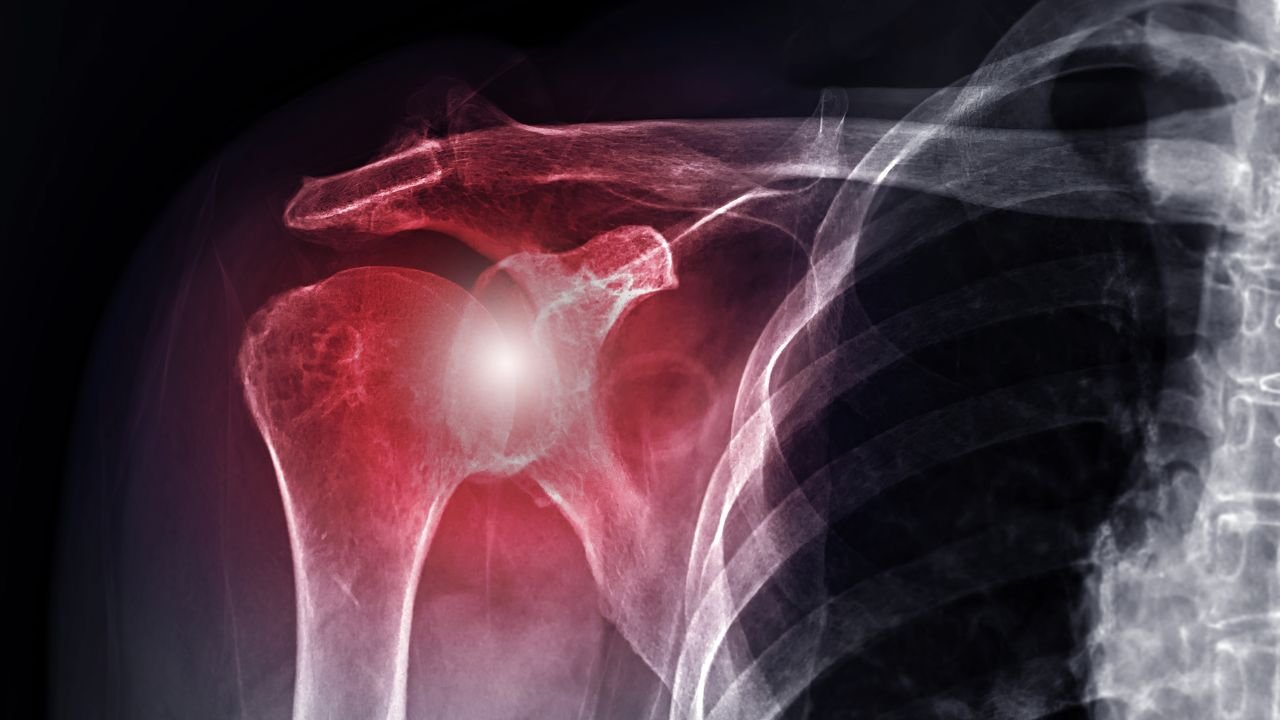 Regenokine for shoulder injuries