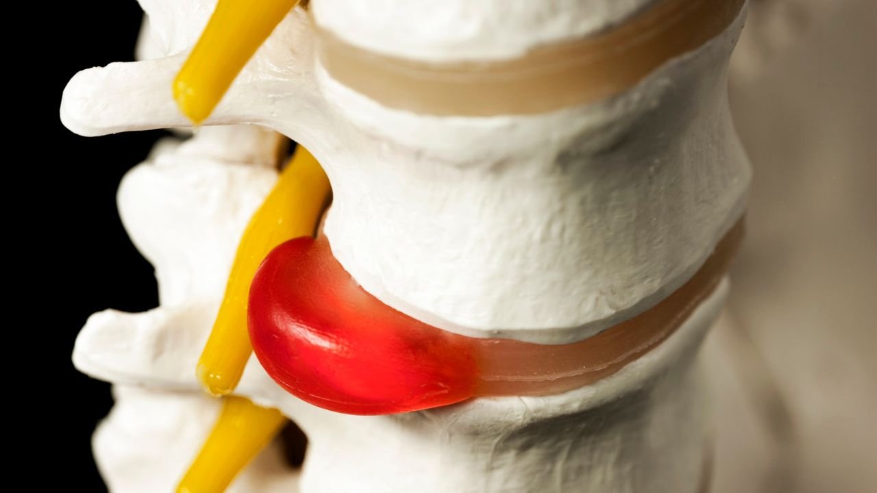 Blog 4 Herniated discs